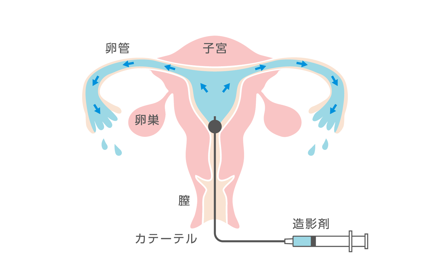 子宮卵管造影検査